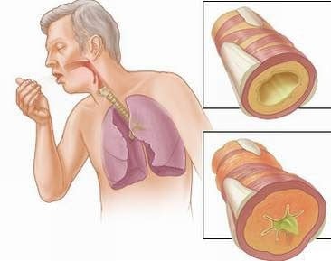 Bronchiectasis - Ảnh minh họa 2