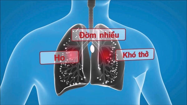 Bronchiectasis - Ảnh minh họa 3