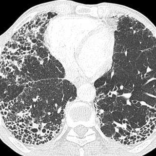 Pulmonary fibrosis - Ảnh minh họa 2