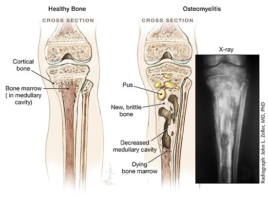 Osteomyelitis - Ảnh minh họa 5