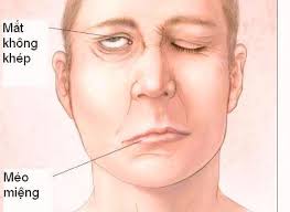 Bell\'s Palsy - Ảnh minh họa 2