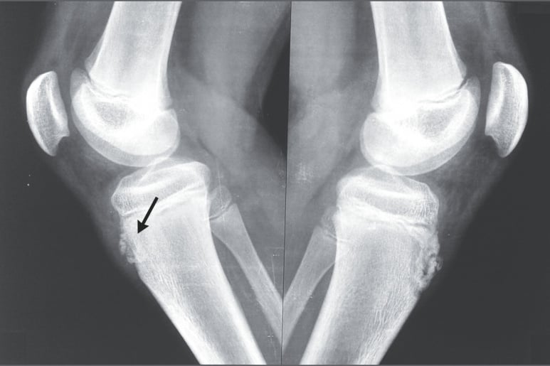 Osgood-Schlatter - Ảnh minh họa 1