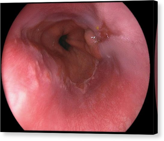 Oesophagitis - Ảnh minh họa 3