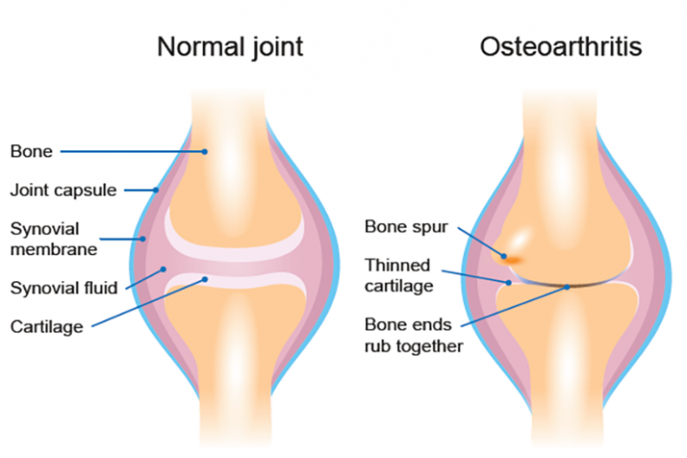 Osteoarthritis - Ảnh minh họa 2