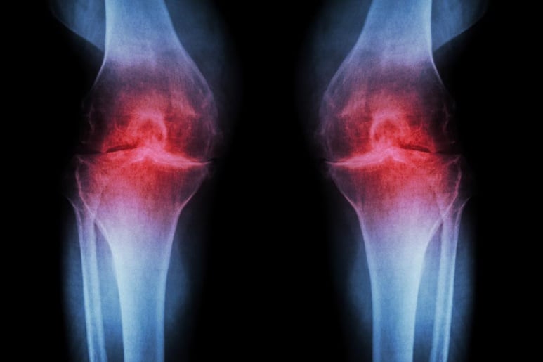 Osteoarthritis - Ảnh minh họa 4