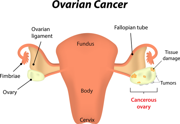 Ovarian cancer - Ảnh minh họa 2