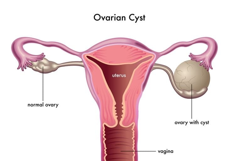 Ovarian Cysts - Ảnh minh họa 3