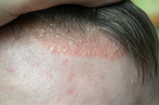 Psoriasis - Ảnh minh họa 4