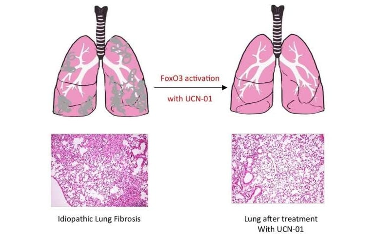 Pulmonary fibrosis - Ảnh minh họa 5