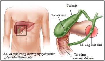 Nhiễm trùng đường mật - Ảnh minh họa 3