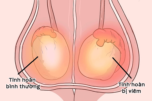 Orchitis - Ảnh minh họa 4