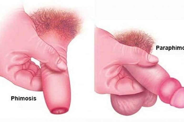 Balanitis - Ảnh minh họa 3