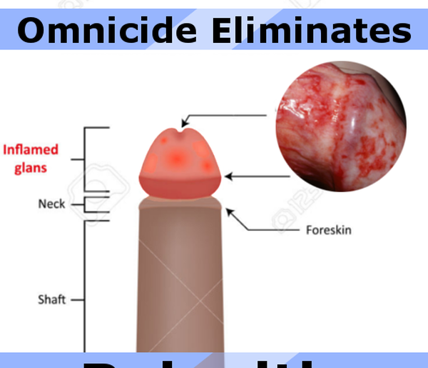 Balanitis - Ảnh minh họa 4