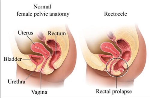 Prolapsed uterus - Ảnh minh họa 1