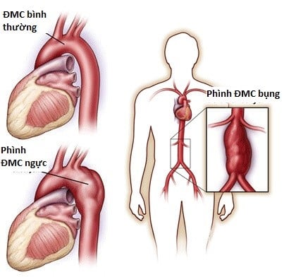 Phình động mạch chủ bụng - Ảnh minh họa 1