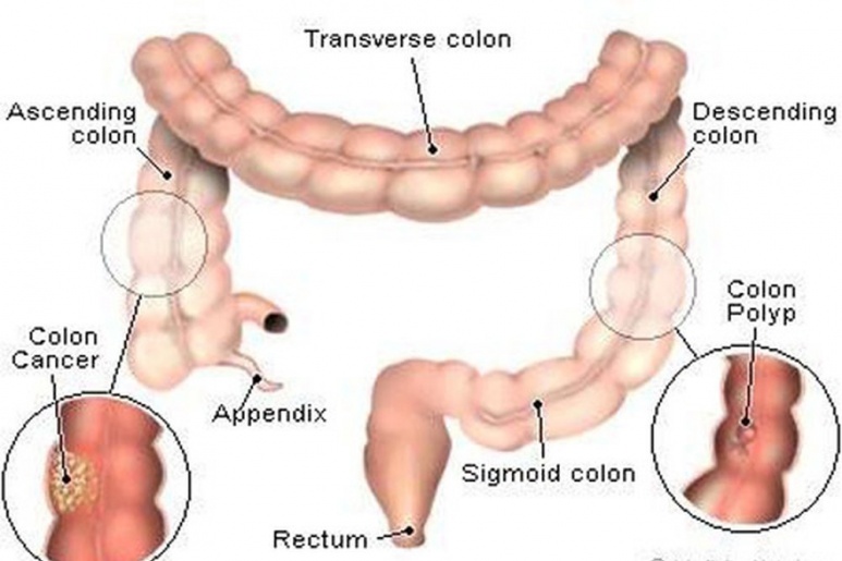 Polyp trực tràng - Ảnh minh họa 1