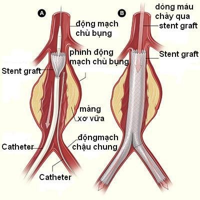 Phình động mạch chủ bụng - Ảnh minh họa 3