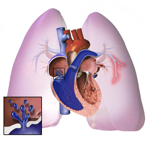 Pulmonary Arterial Hypertension - Ảnh minh họa 2