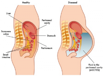 Peritonitis - Ảnh minh họa 1