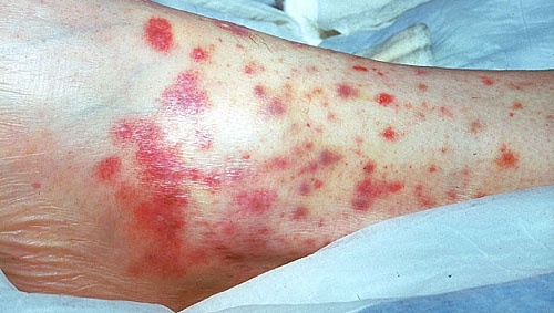 Polyarteritis nodosa - Ảnh minh họa 1