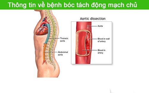 Bóc tách động mạch đốt sống - Ảnh minh họa 2