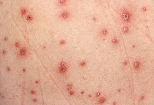 Bullous pemphigoid - Ảnh minh họa 1