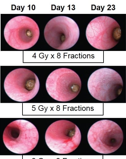 Proctitis - Ảnh minh họa 2