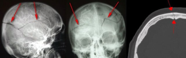 Basilar Skull Fracture - Ảnh minh họa 2