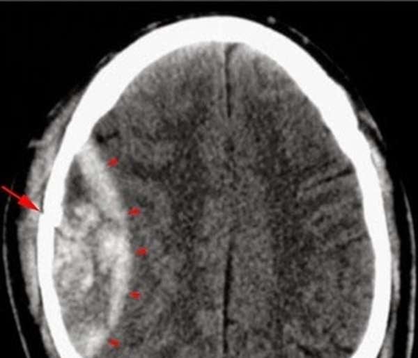 Basilar Skull Fracture - Ảnh minh họa 3