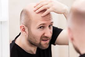 Baldness - Ảnh minh họa 2