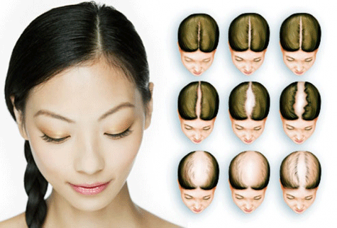 Baldness - Ảnh minh họa 4