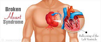 Breaken heart syndrome - Ảnh minh họa 2