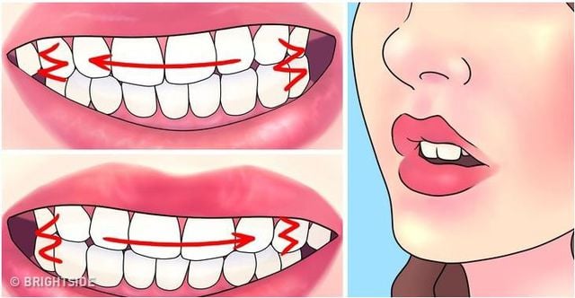 Bruxism - Ảnh minh họa 2