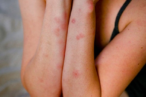 Bed bugs bite - Ảnh minh họa 3