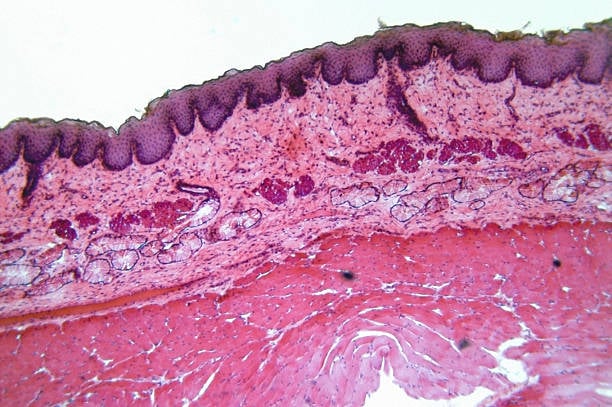 Basal cell carcinoma - Ảnh minh họa 1