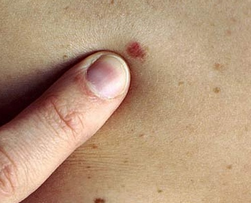 Basal cell carcinoma - Ảnh minh họa 2