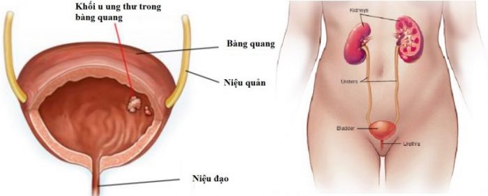 Bladder cancer - Ảnh minh họa 3