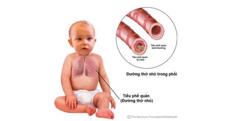 Bronchiolitis - Ảnh minh họa 1