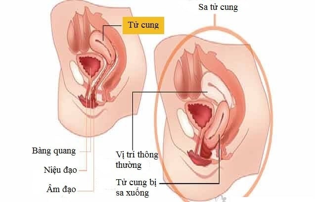 Prolapsed uterus - Ảnh minh họa 2