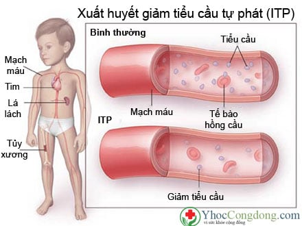 Ban xuất huyết giảm tiểu cầu tự phát (ITP) - Ảnh minh họa 1