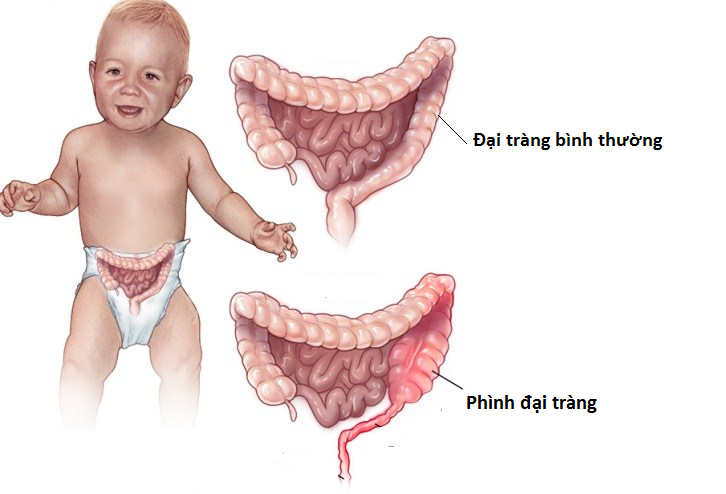 Phình đại tràng nhiễm độc - Ảnh minh họa 5