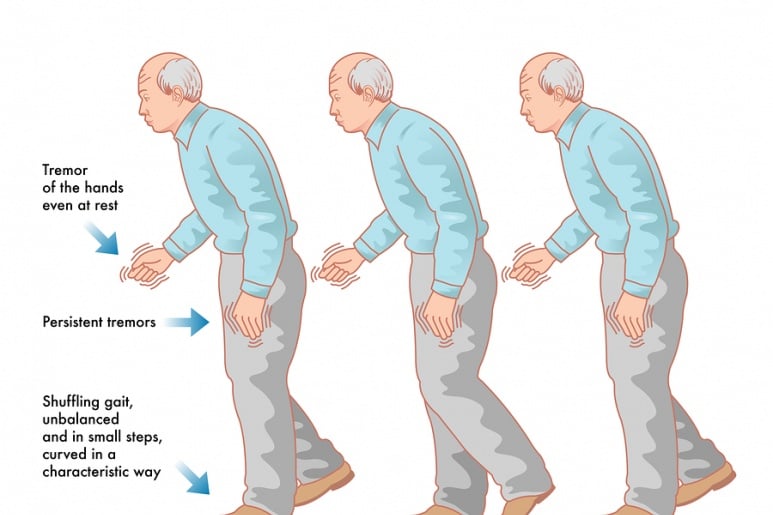 Parkinson - Ảnh minh họa 1