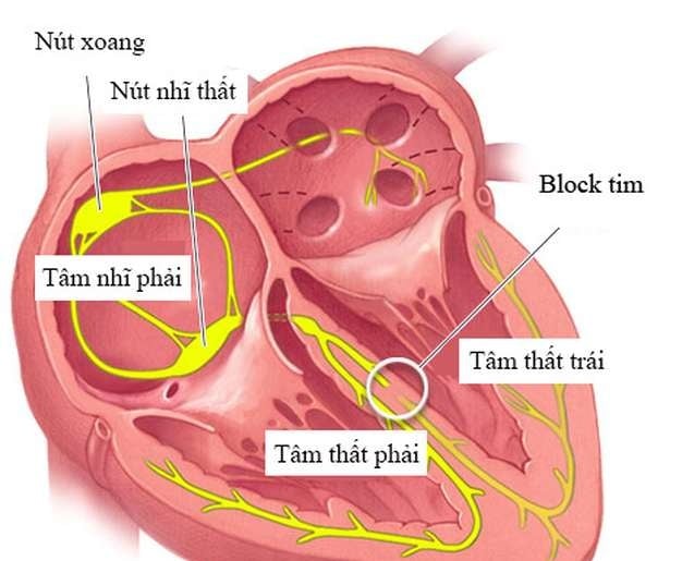 Blốc nhĩ thất - Ảnh minh họa 1