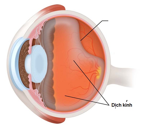 Bong dịch kính sau - Ảnh minh họa 1