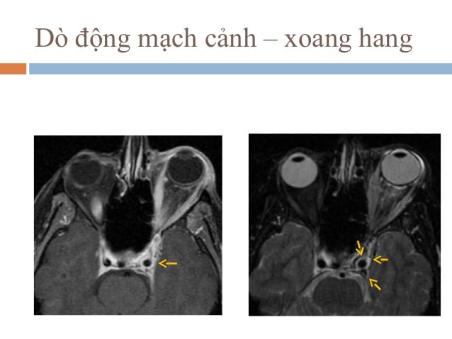 Phình động mạch xoang hang - Ảnh minh họa 3