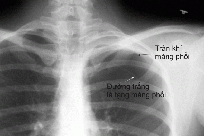 Pneumothorax - Ảnh minh họa 2