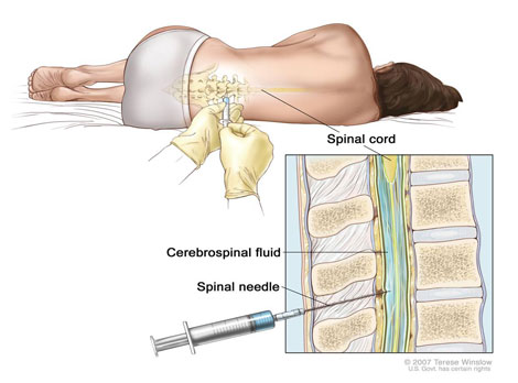 Peritonitis - Ảnh minh họa 4