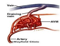 Brain arteriovenous malformation - Ảnh minh họa 3