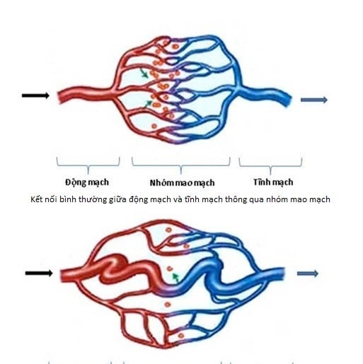 Brain arteriovenous malformation - Ảnh minh họa 4