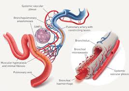 Pulmonary Arterial Hypertension - Ảnh minh họa 3